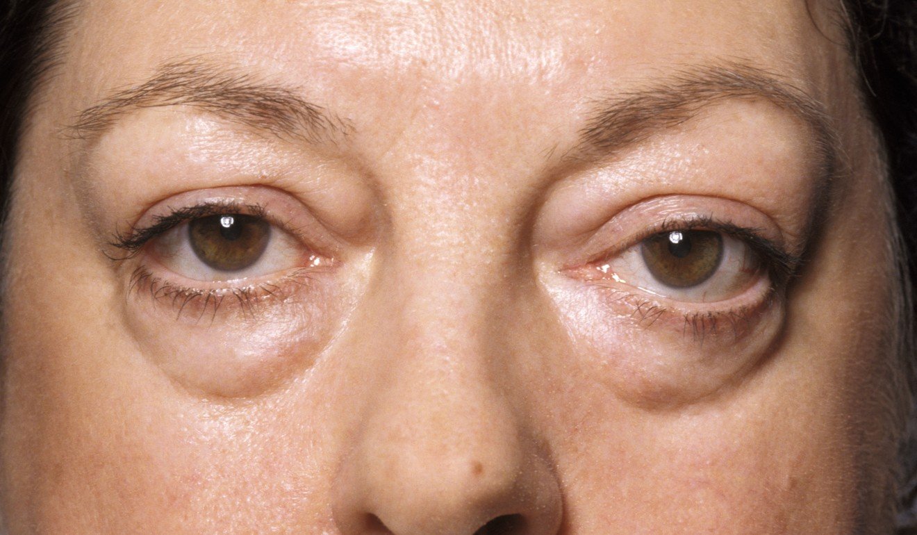 Glaucoma can cause the eyeballs to bulge.