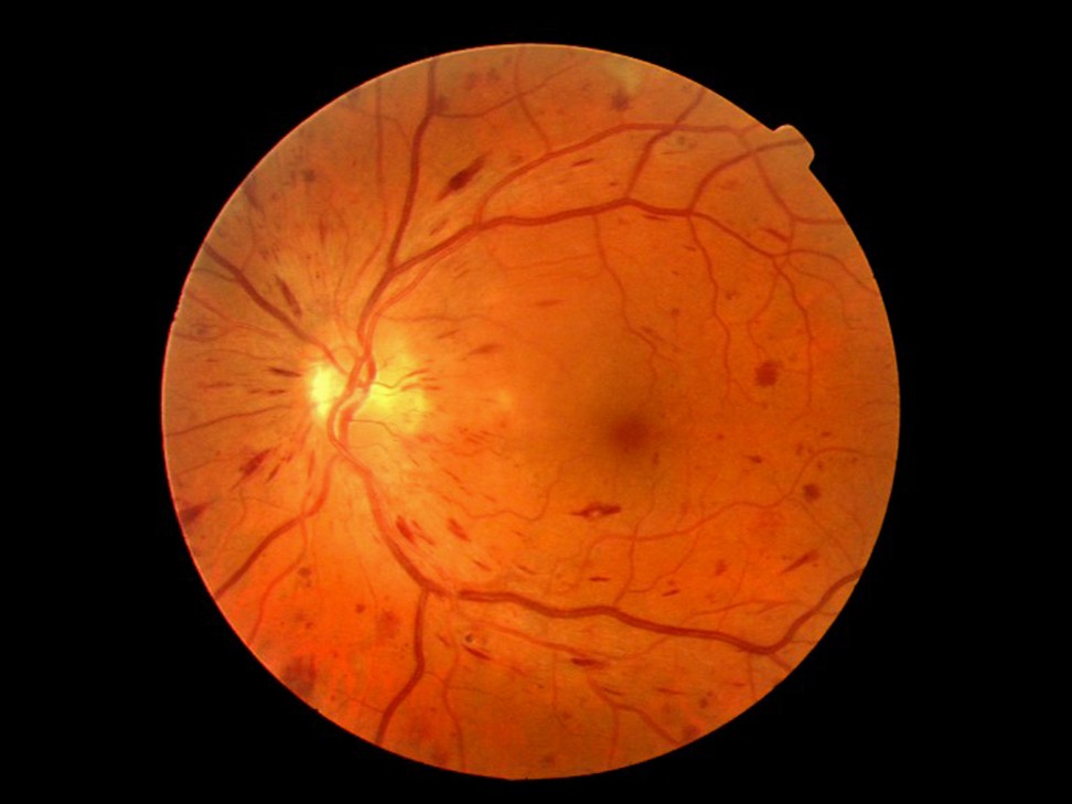 An ophthalmoscope image of the retina showing acute non-proliferative diabetic retinopathy. Photo: Alamy