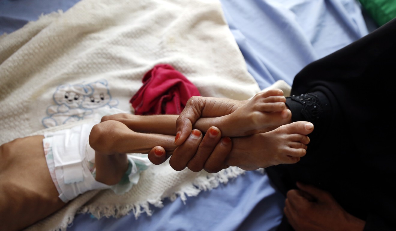 A malnourished child at a hospital in Hajjah province, Yemen. Photo: Xinhua