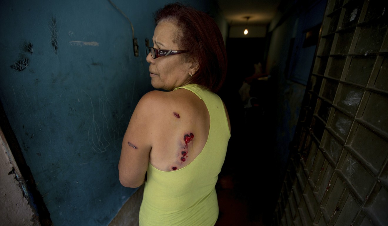 Carmen Marcano, a Cotiza neighbourhood resident, shows her wounds caused by rubber bullets fired by Venezuelan Bolivarian National Guardsmen during a protest in response to the arrest of National Guardsmen who mounted an uprising against President Nicolas Maduro. Photo: AP