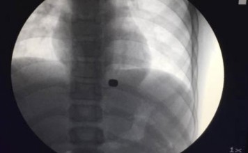 An X-ray shows how the magnets had become stuck in the boy’s stomach. Photo: China News