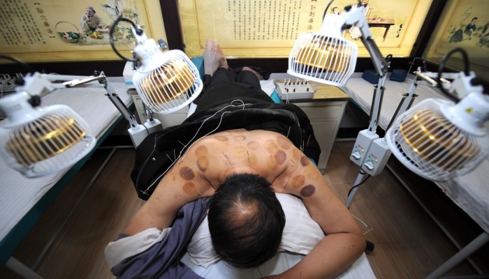 A man receives acupuncture treatment at a hospital in Wuwei, northwest China's Gansu province. Photo: Xinhua