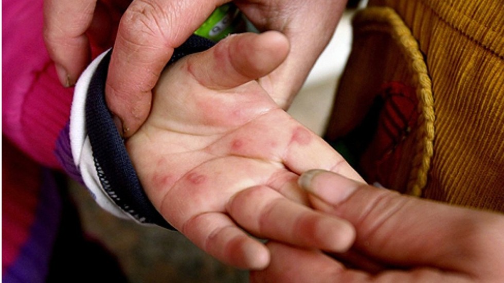 A ‘cure’ for hand, foot and mouth disease? Shanghai team say D5
