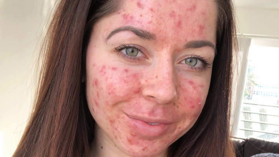 Acne: why adults it, how to treat it, and one Instagrammer's battle with acne